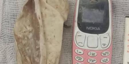 الفريق الطبي بمستشفى ناصر العام بشبرا ينجح في استخراج "موبيل" من معدة مريض بعد 4 شهور (صور)