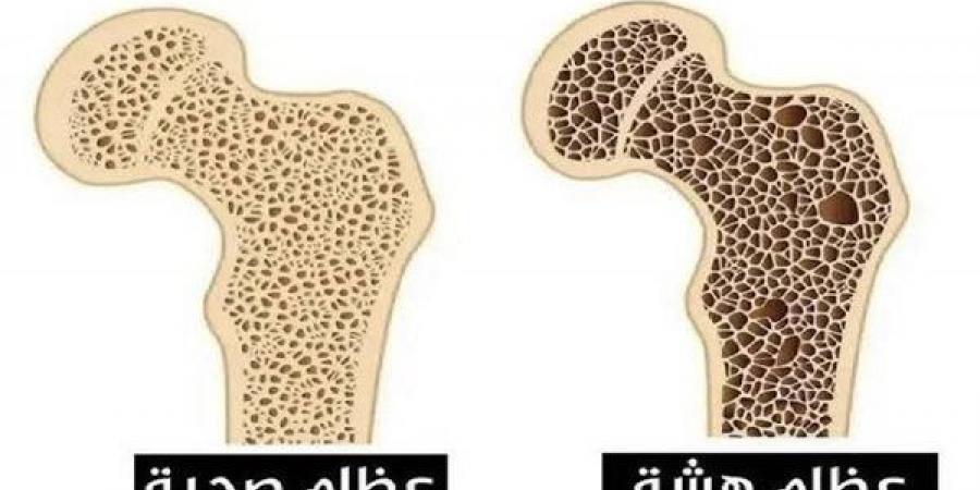 ماهو اضطراب الميلاتونين الذي يسبب هشاشة العظام؟